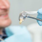 Estrarre un dente fa male? Scopri di più sull’estrazione