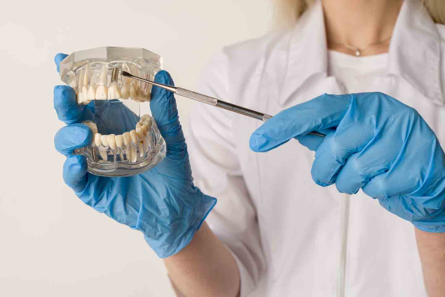 tecniche di implantologia dentale denti impianto dentale mano guanti blu spiegazione