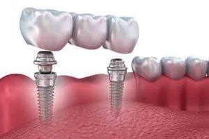 tecniche di implantologia dentale ponte denti viti impianto dentale