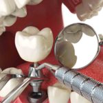 Impianto dentale molare: scopri tutto quello che c’è da sapere!