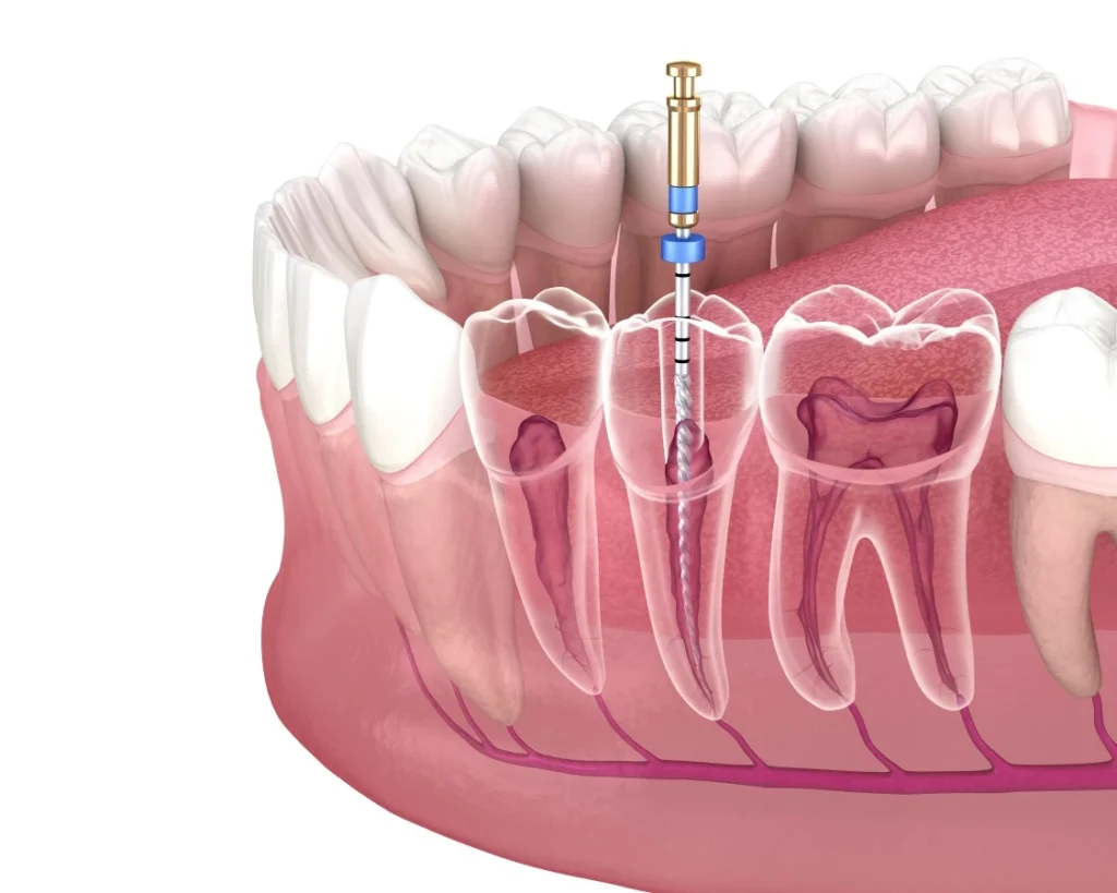 Endodonzia a Pesaro