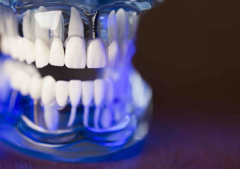 Blog 3 Cosa si può mangiare dopo un impianto dentale