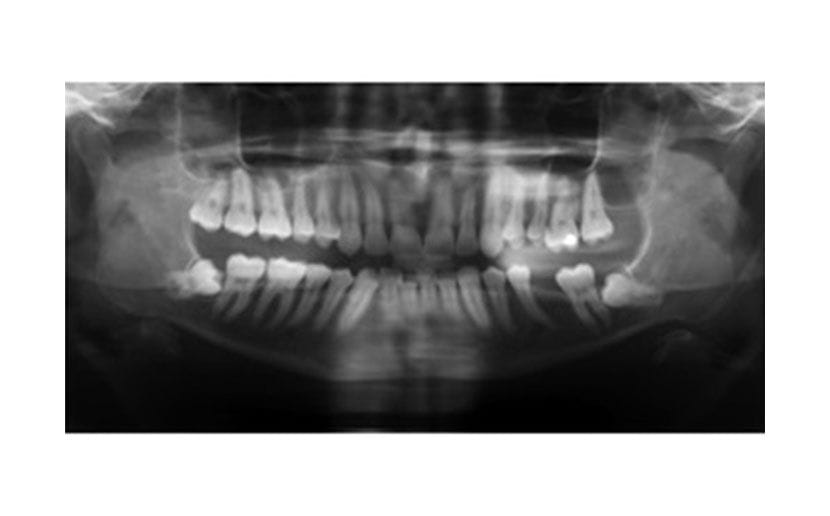 Denti del Giudizio Inclusi 7 denti del giudizio IMGEV2