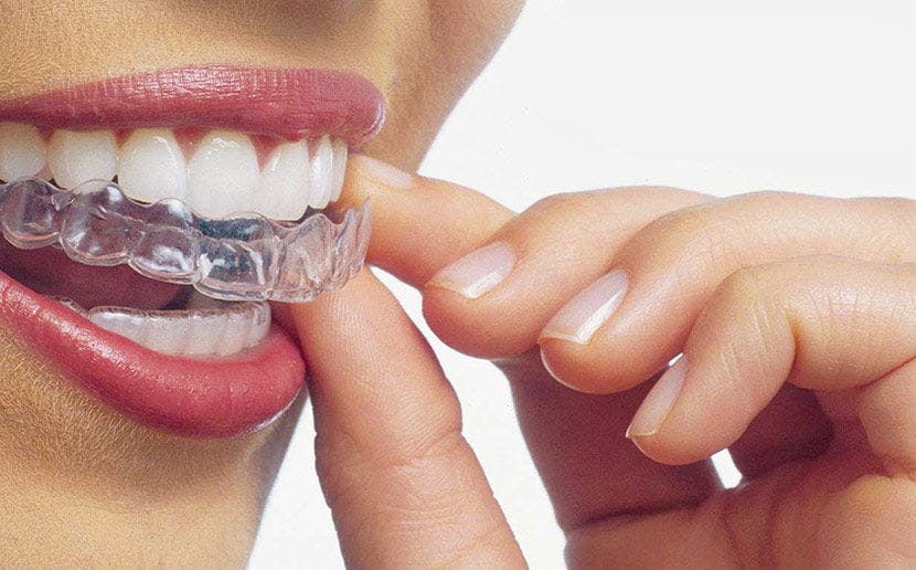Ortodonzia Invisibile 5 orto invisibile